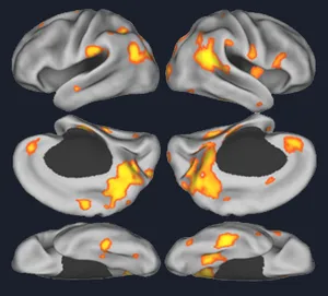 Brain scans showing enhanced hippocampal activity